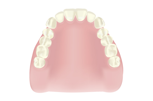 レジン床義歯