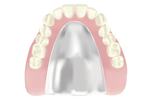 コバルトクロム床義歯