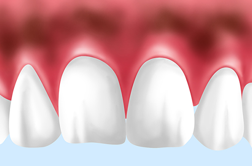 歯ぐきが黒ずむリスク
