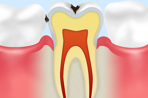 C1：初期の虫歯
