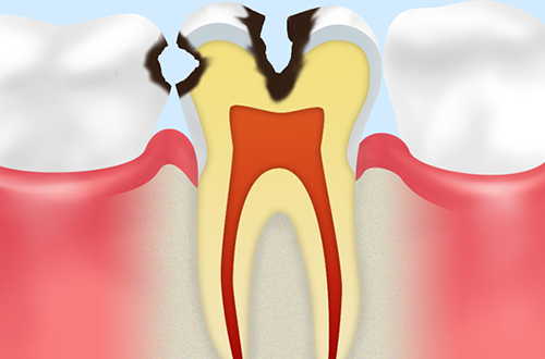 C2：歯の内部まで進行した虫歯
