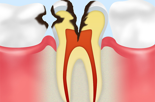 C3：神経まで進行した虫歯