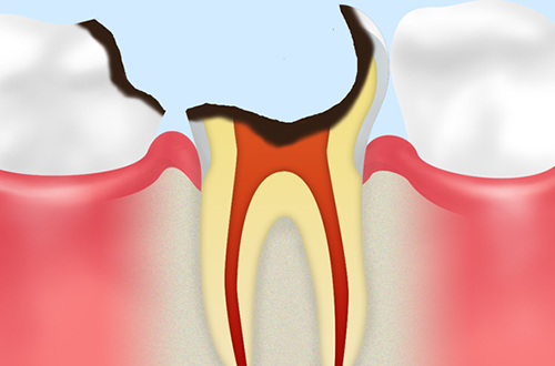 C4：歯冠が大きく失われた虫歯