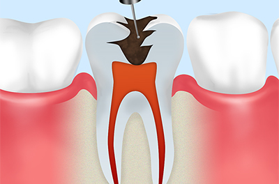 感染歯質を削って根管を露出させる