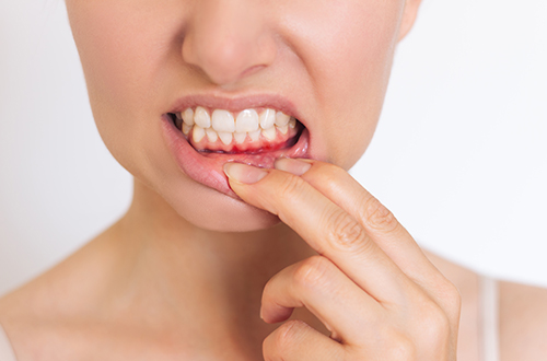 歯周病の原因は歯にこびりつくプラーク