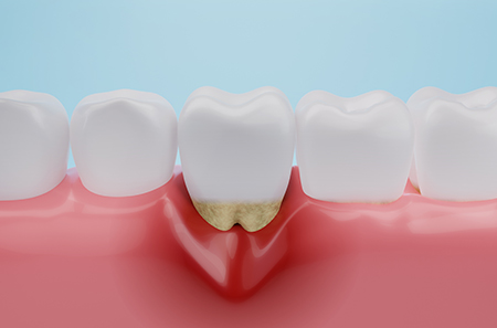 歯周病にかかりやすくなる生活上の要因