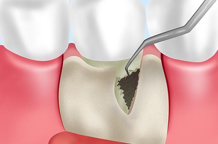 重度の歯周病を治し再発予防につながる外科手術「フラップ手術」