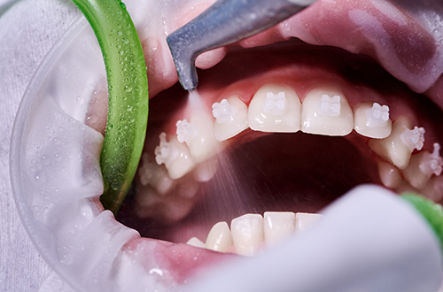 エアフローで隅々まできれいにして虫歯・歯周病予防！