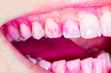 染め出しで磨き残しを視覚化する